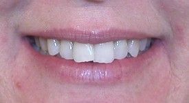 invisalign-before-1