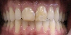 porcelain-crowns-before-2