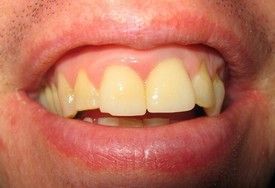 porcelain-crowns-before-5