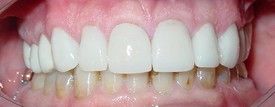 porcelain-veneers-after-4