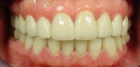 porcelain-veneers-after-6