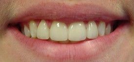 porcelain-veneers-after-7