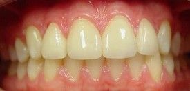 porcelain-veneers-after-8