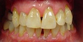 porcelain-veneers-before-2