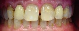 porcelain-veneers-before-4