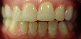 porcelain-veneers-before-6