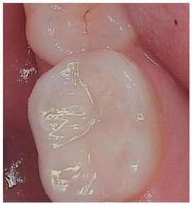 white-composite-fillings-after-1