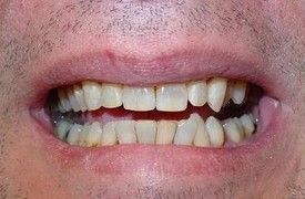 white-composite-fillings-after-3