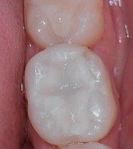 white-composite-fillings-after-6