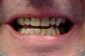 white-composite-fillings-before-3