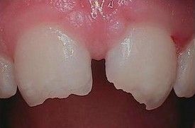 white-composite-fillings-before-5